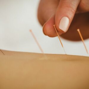 Acupuntura
