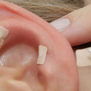 Auriculoterapia