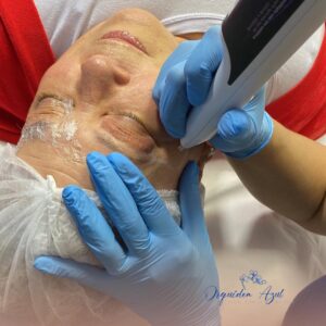 Blefaroplastia Sem Corte